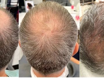 Procell stem cell hair therapy, microchanneling , microneedling , bold, hair loss, age, grey hair, 