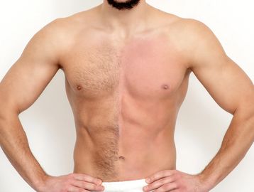 Back waxing, male waxing, hair removal, shoulder hair removal, chest hair removal, nasal hair