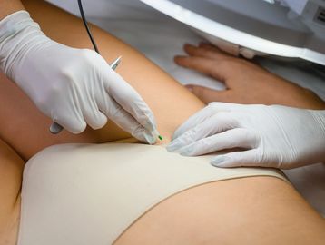 body hair, bikini line, permanent hair removal, painless hair removal, Auckland electrolysis