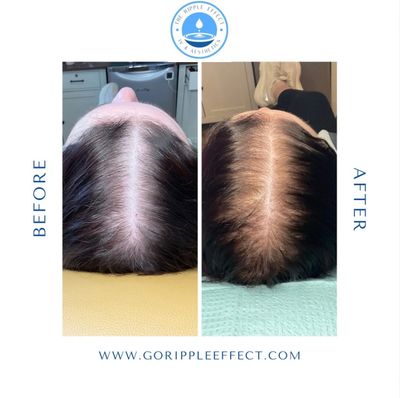 Before and after images showing improved hair density on the scalp.