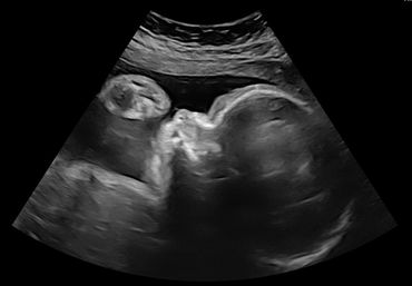 2d-baby-scan-reassurance-scan-manchester