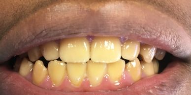Dental bonding, bonding for teeth, teeth whitening, smile makeover