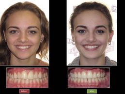 Invisalign, clear braces, financing braces, invisible orthodontics, spaces in my teeth