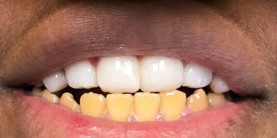 Dental bonding, teeth bonding