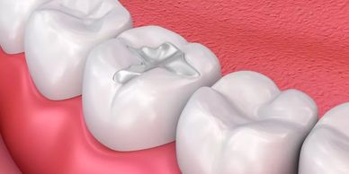 Fillings