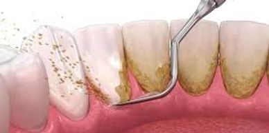 Non-surgical gum disease treatment