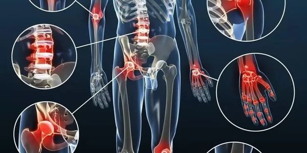 Human skeleton highlighting common joint pain areas in red.