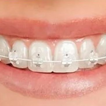 Ask Your Blanco Dentist: Should I Get Metal or Clear Braces? Blanco Dental  Center, TX