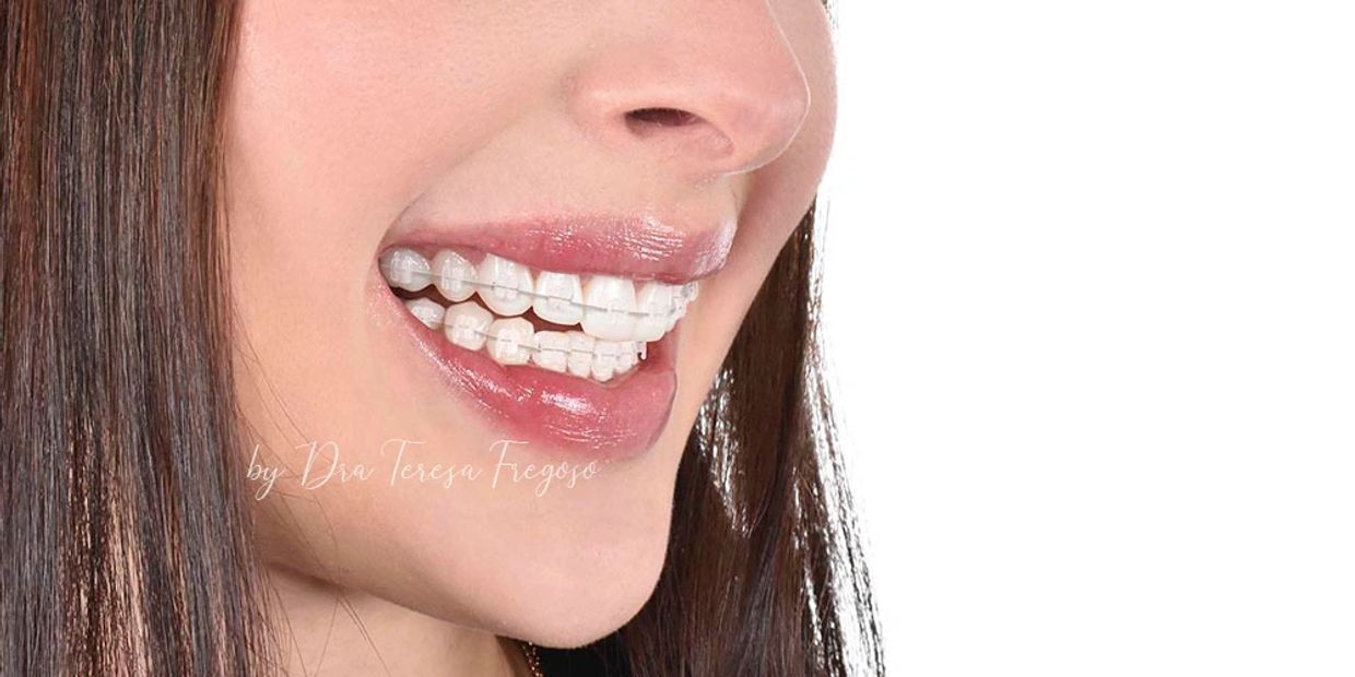 Sonrisa con alineadores dentales transparentes.