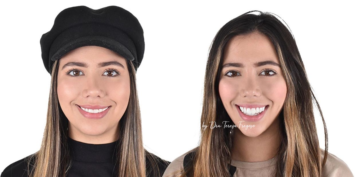 Diseño de Sonrisa, Odontología, Carillas dentales, Carillas de Resina, Bichectomia, Dientes, bichat
