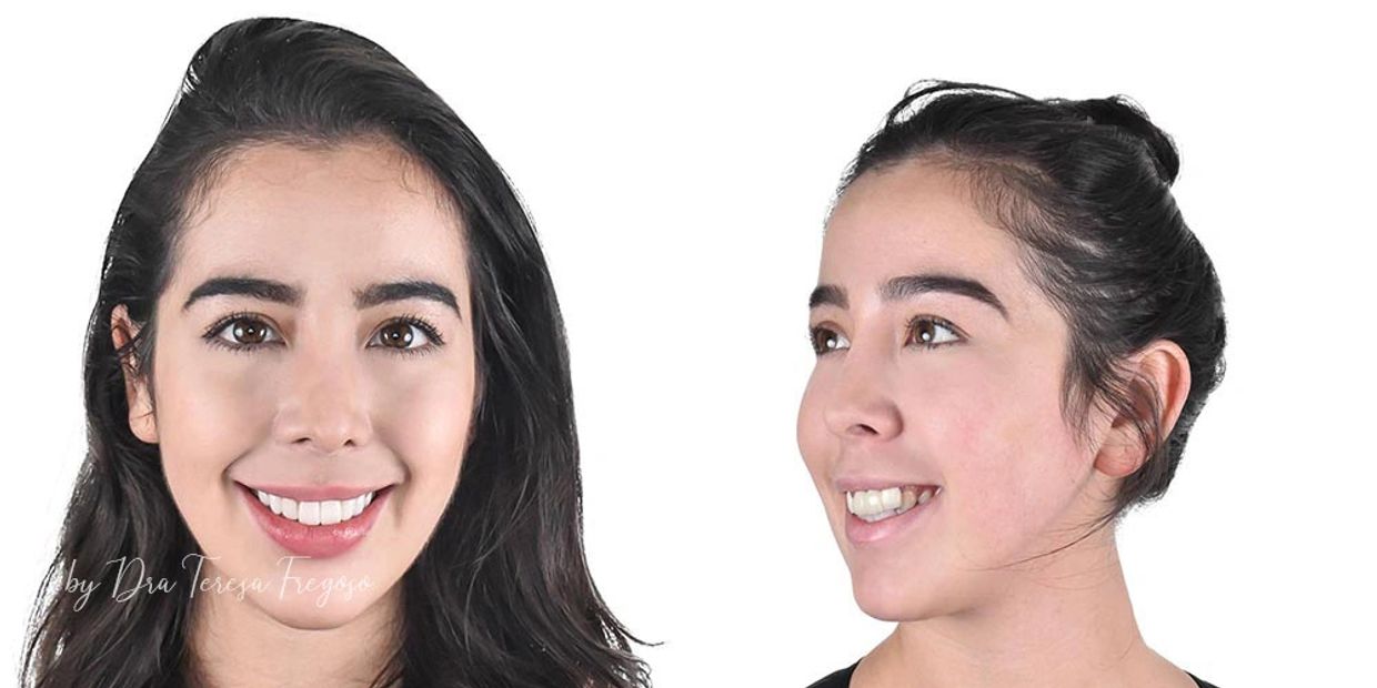Diseño de Sonrisa, Odontología, Carillas dentales, Carillas de Resina, Diseño, Dientes, Sonrisa