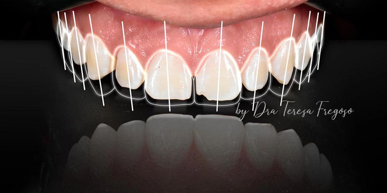 Diseño de Sonrisa, Odontología, Carillas dentales, Carillas de Resina, Diseño, Dientes, Smile Design