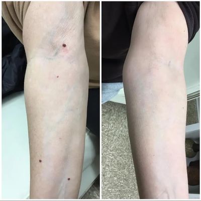 After 1 Treatment