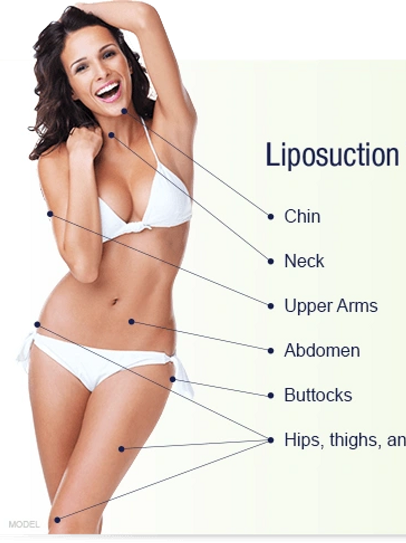 BodyTite Liposuction RFAL vs Liposuction