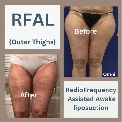 RFAL and VASER Liposuction in Toronto