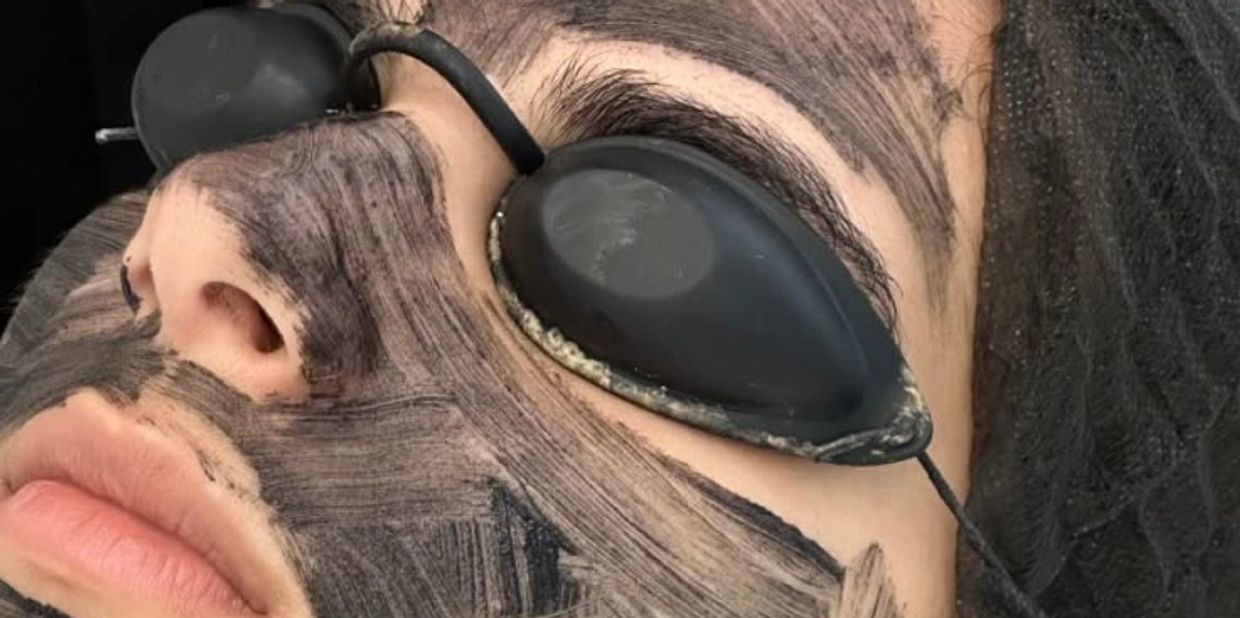 A lady getting a carbon laser facial with goggles on to protect her eyes