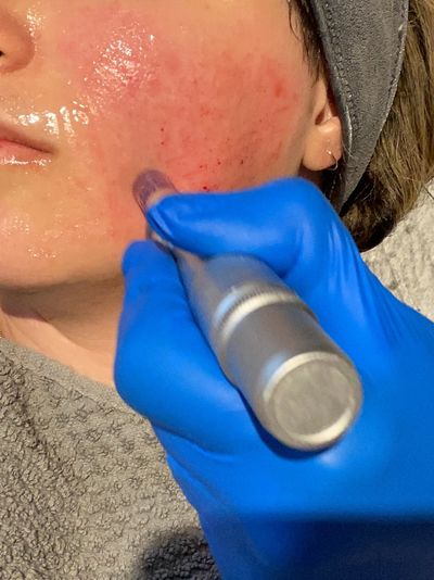 Micro Needling, also referred to, as Collagen Induction Therapy, 