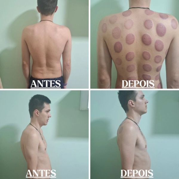 Fotos de antes e depois mostrando tratamento com ventosas nas costas.