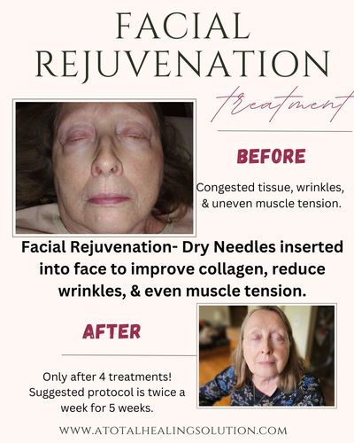 Before and after the treatment of facial rejuvenation.