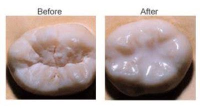 Close-up of a tooth before and after dental treatment.