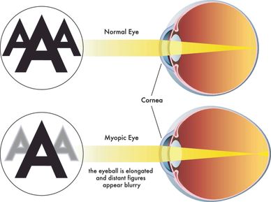 myopia