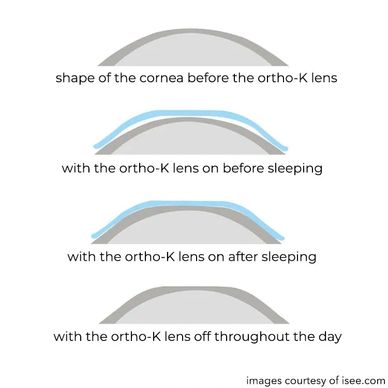 Diagram showing cornea shape changes with ortho-K lens use and removal.