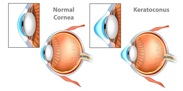 Comparison of normal cornea and keratoconus-affected eye anatomy.