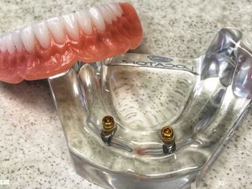 DENTURE AND IMPLANTS. 