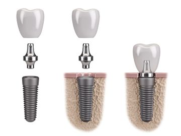 DENTAL IMPLANT 