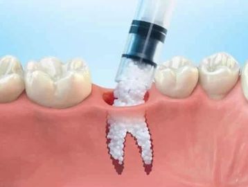 bone graft