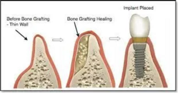 bone graft