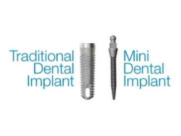 dental implants