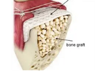 bone graft