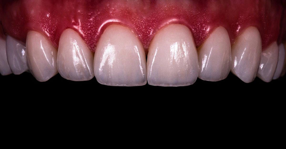 high aesthetic veneers, crowns
