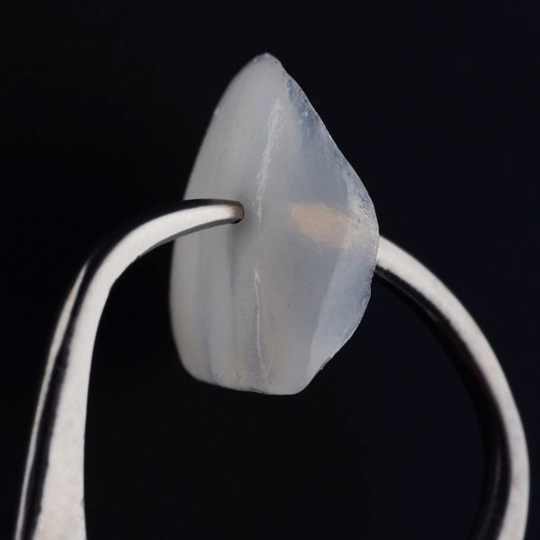 Keramički -feldspatic veneers
