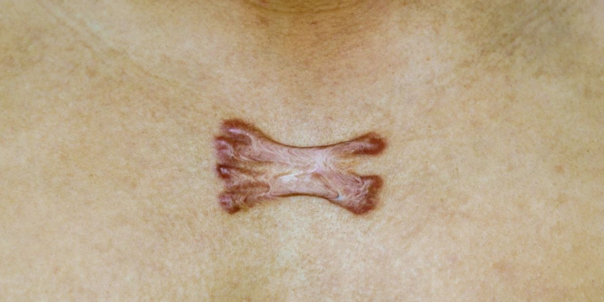 Keloid Treatment Penang