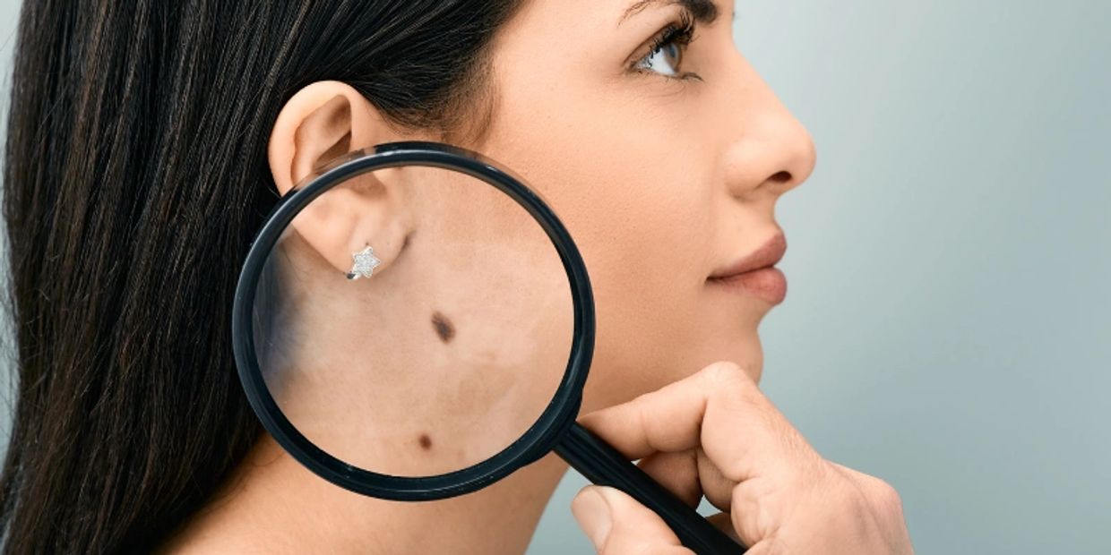 Mole and birth mark removal in penang