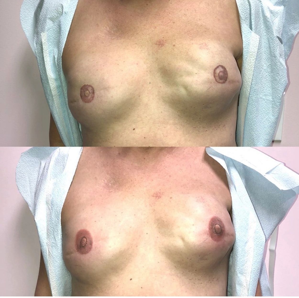 Bilateral corrective tattooing before and after. First Session. Work originally done by clients surg