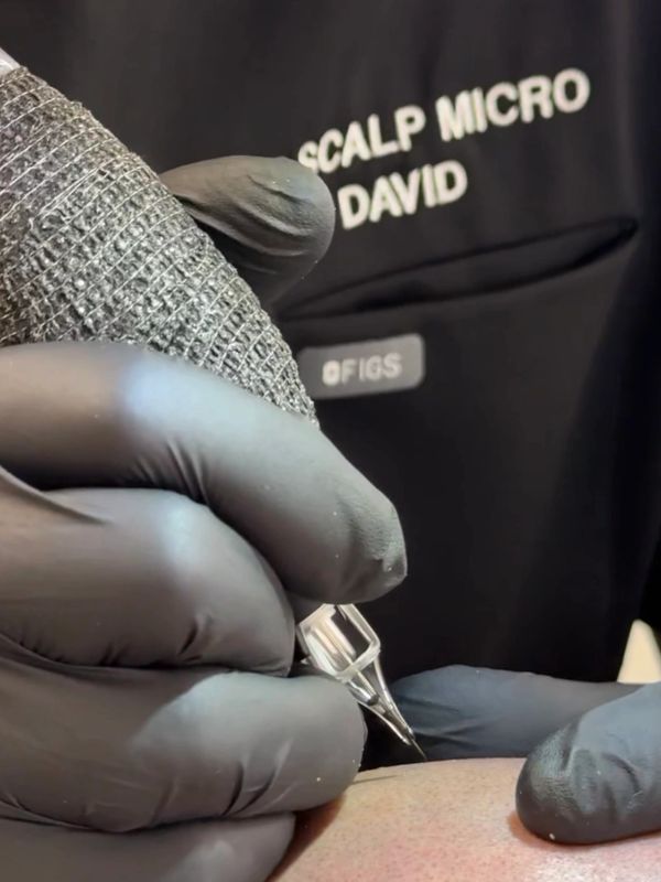 Close-up of David at DC Scalp Micro performing scalp micropigmentation, wearing black gloves and usi
