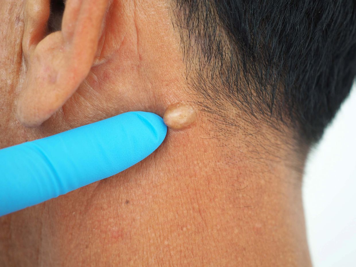 Close-up of a finger with a blue glove touching a skin bump behind the ear.