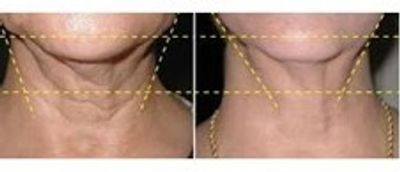 Skin Rejuvenation Treatment - Neck lift by IPL treatment- Before and After Pictures