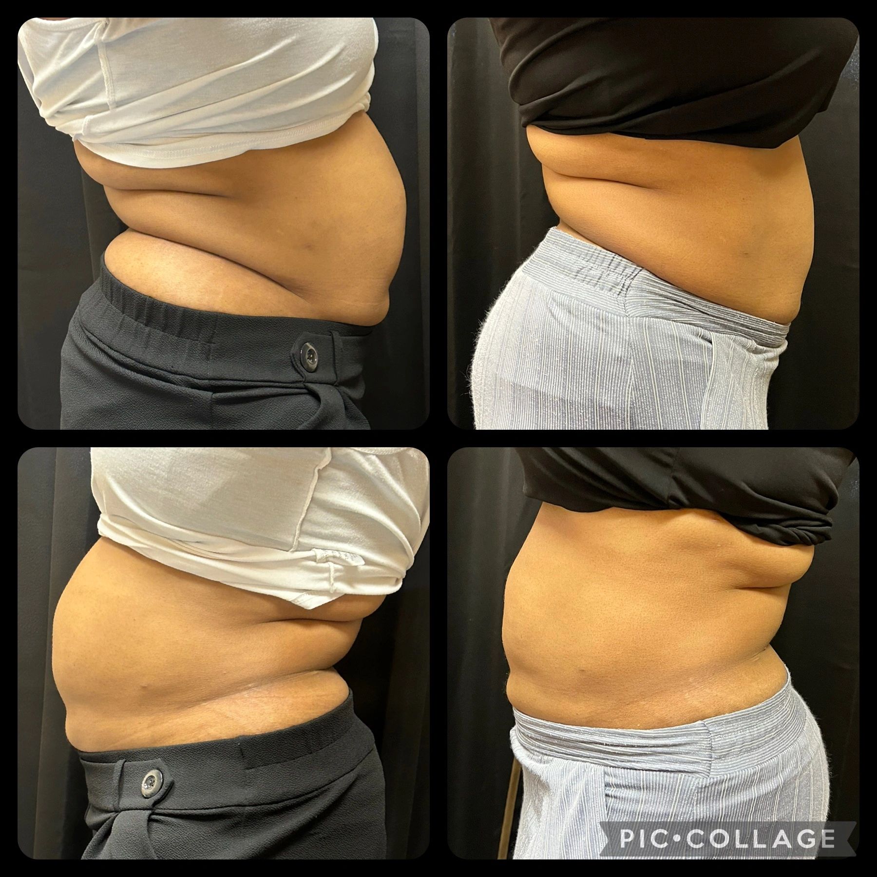Lipo B Shot, Semaglutide, Body Sculpting, Skin Tightening, Weight Loss,  Lipo Laser - Island Beauty Aesthetics