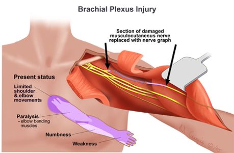 medical illustration of brachial plexus injury