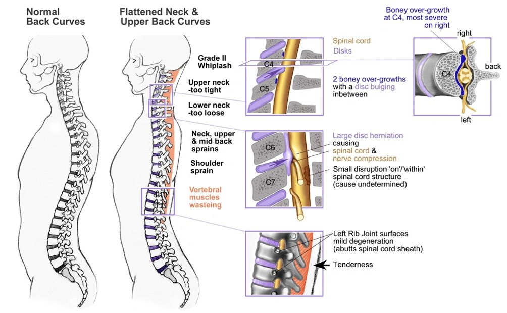 Medical illustration of spinal injuries, disc herniation
 