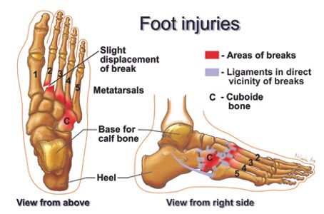 medical illustration of anatomy of personal injury to the foot