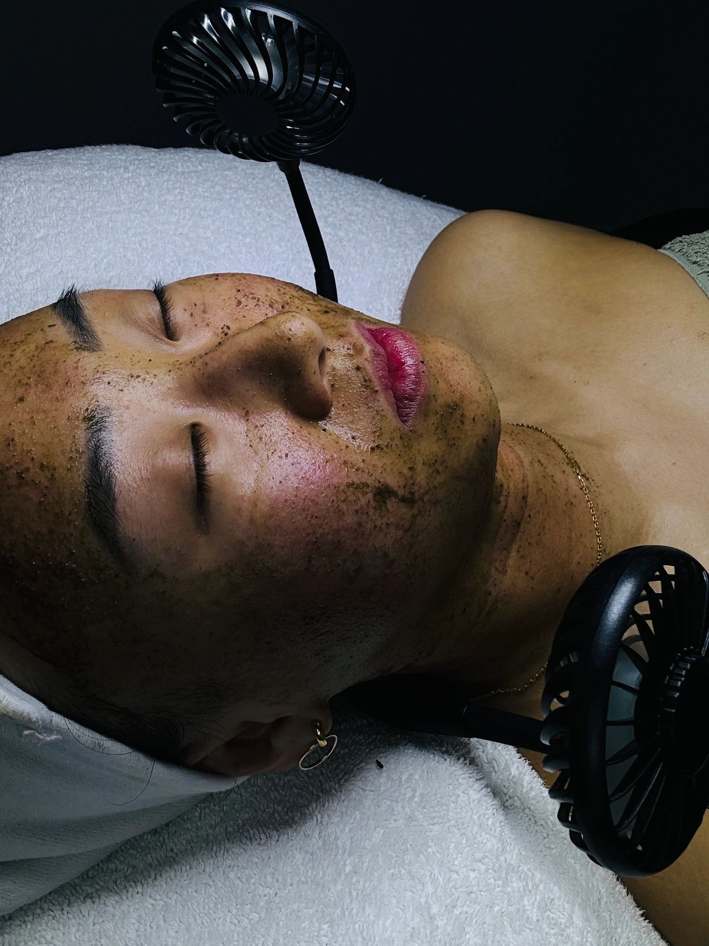  Facials in Ajax, chemical peel and microneedling in Scarborough medspa, skincare clinic, acne  