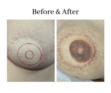 Before (mapping) and after image of 3D Areola Tattoo on post-mastectomy breast cancer survivor. 