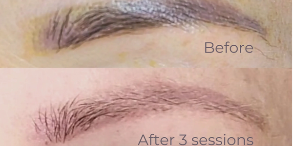 Saline Tattoo Lightening before and after, three sessions healed, showing less saturation remaining