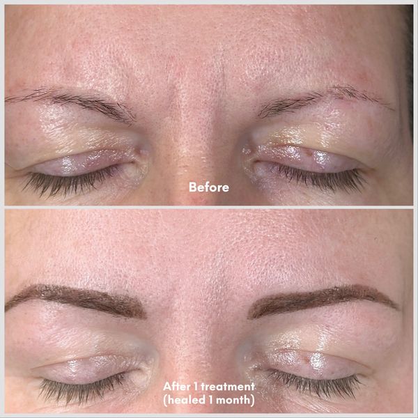 before and after close up images of fibroblast plasma therapy treatment on 11s and henna brows.
