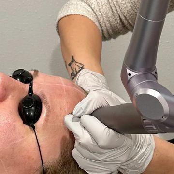 Blonde woman's face, wearing protective eye goggles, as provider's hands use pico laser on her face.